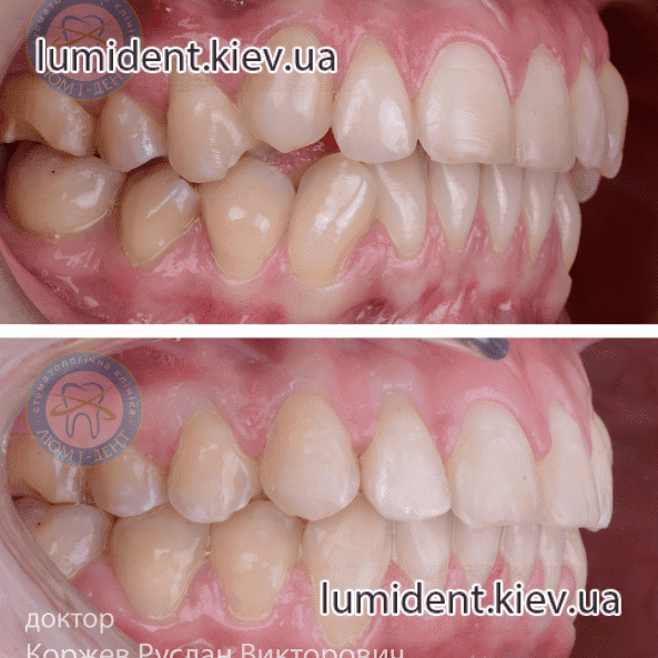 Подготовка зубов к имплантации и протезированию