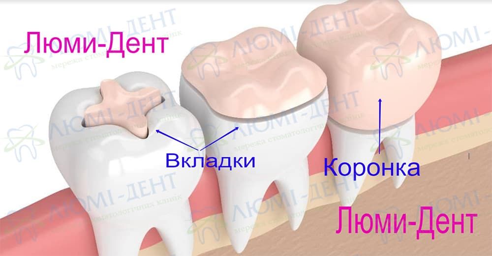 Зубные коронки фото до и после