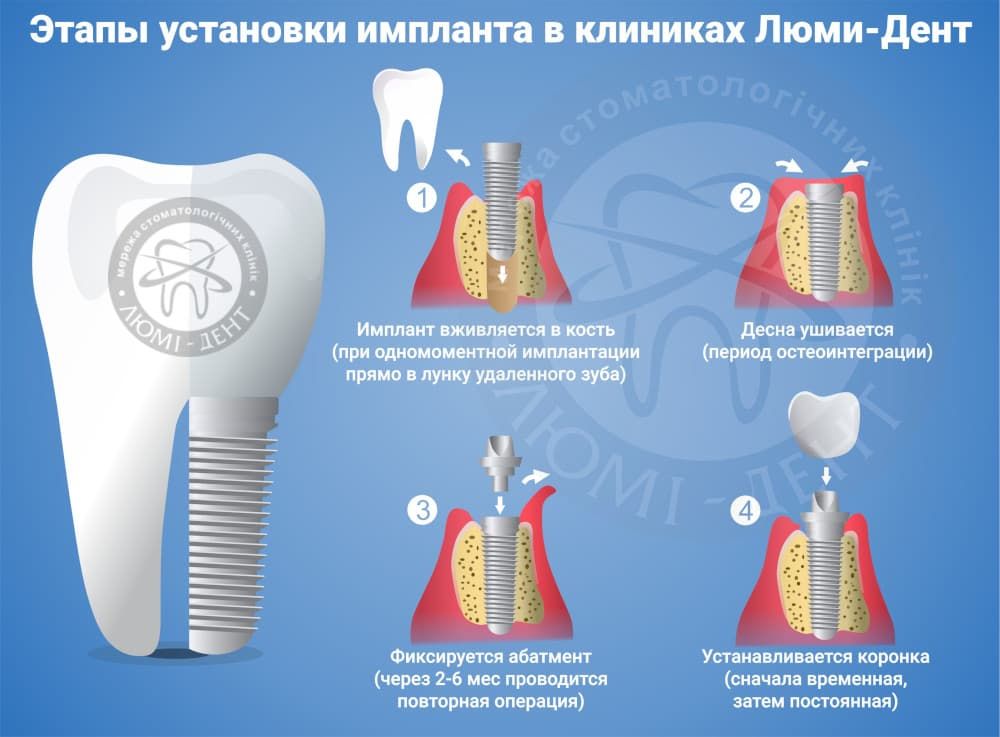 Костная пластика фото