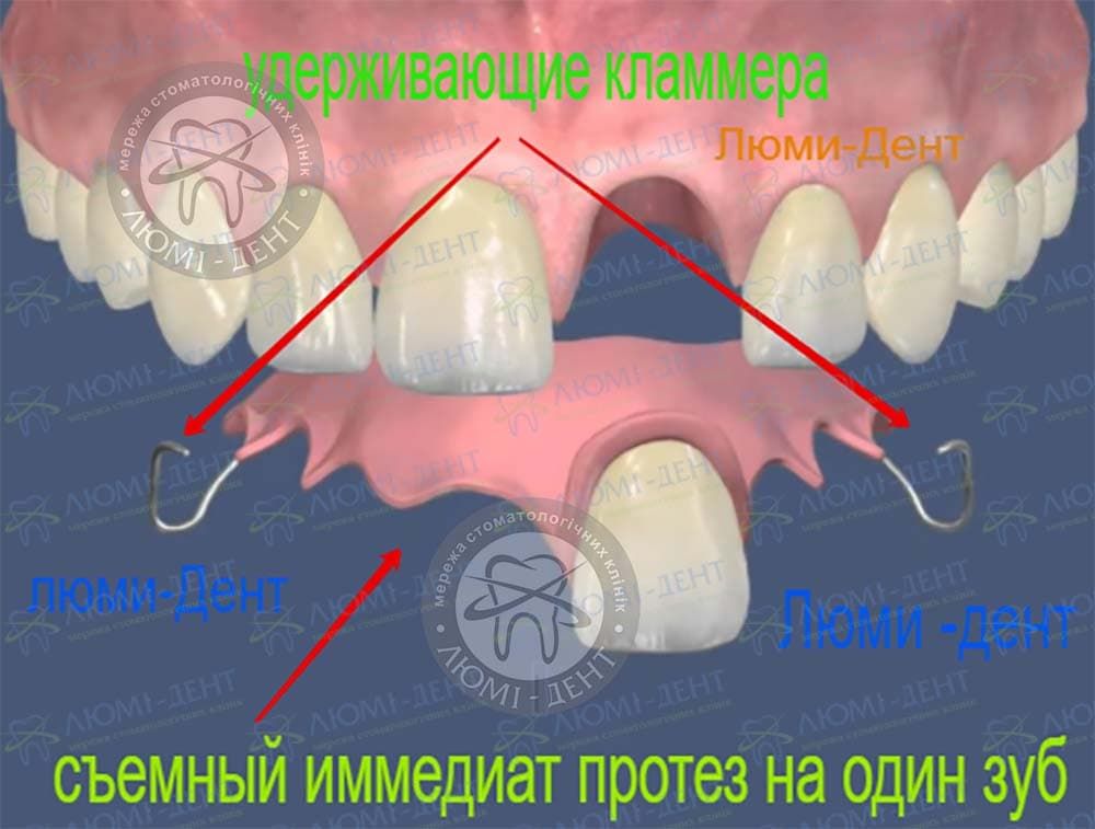 Протез на один зуб фото