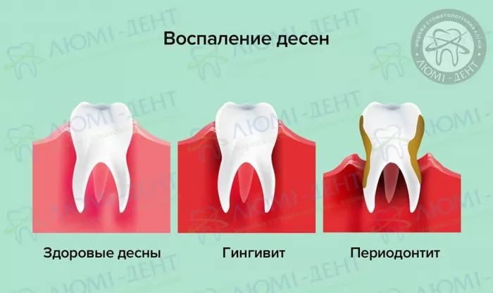 Причины воспаления десен Воспалилась десна чем полоскать фото Люми-Дент