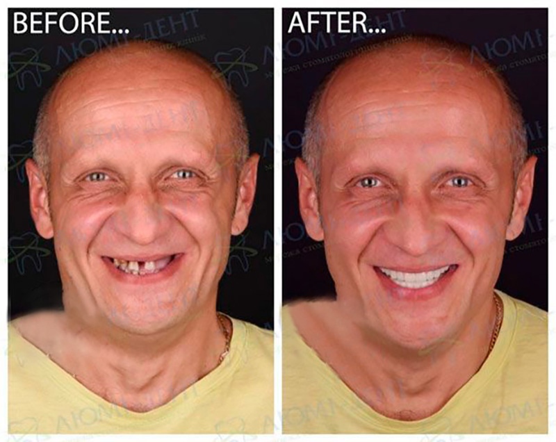 Lumi-Dent Dental Implants Results after dental implantation Dental-Implants-Lumi-Dent