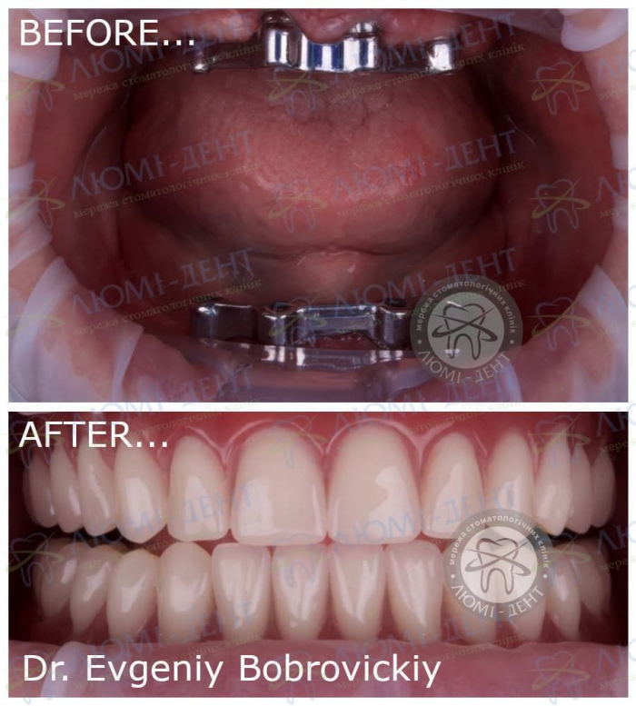 Какие бывают съемные протезы для зубов на нижней челюсти фото