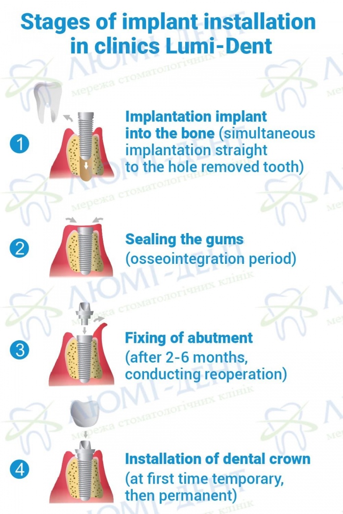 Stages of dental implant placement at Lumi-Dent Dental implants price photo Lumi-Dent