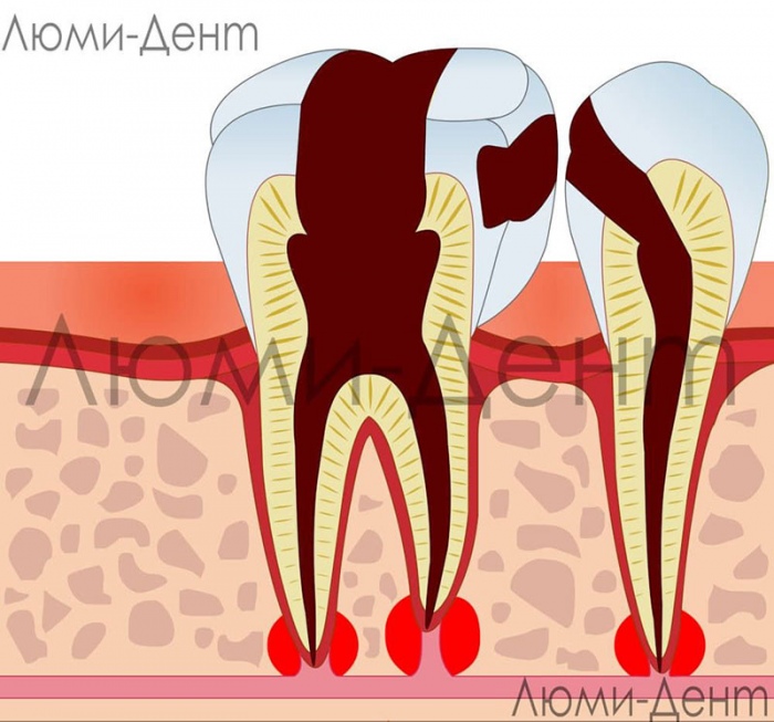 Периодонтит зуба фото Люми-Дент
