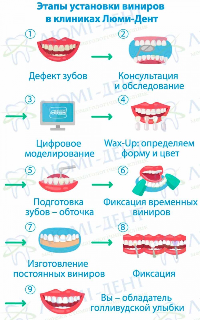 виниры на нижние зубы фото Люми-Дент