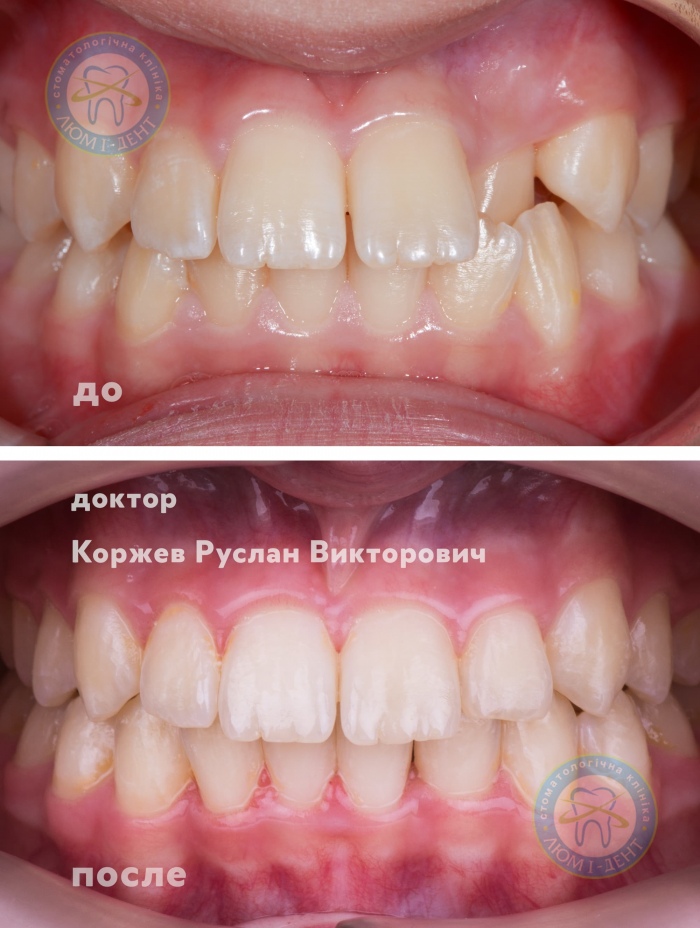 Когда снимают брекеты фото Киев Люми-Дент