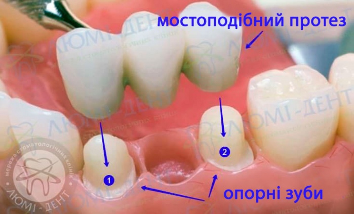 зубний міст відгуки фото Люмі-Дент