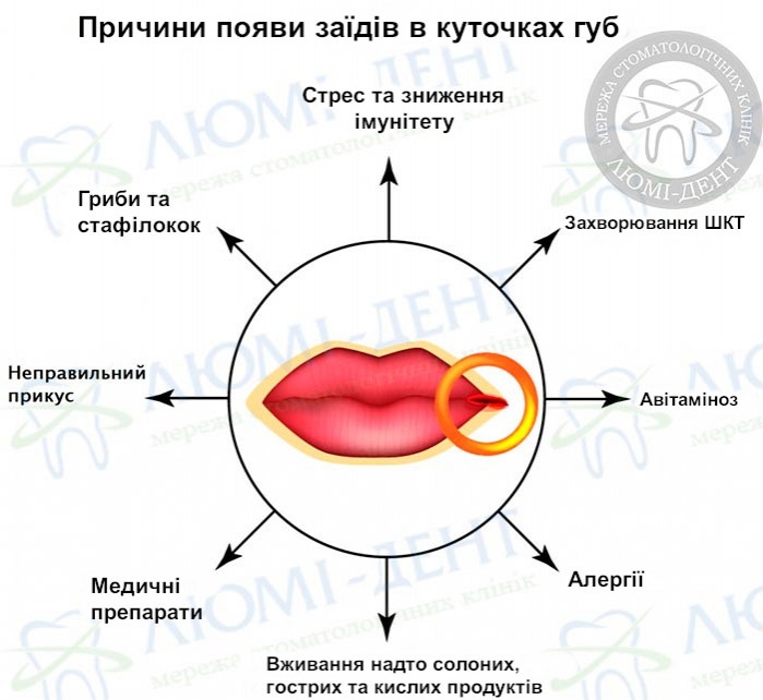 Заїди на губах фото ЛюміДент