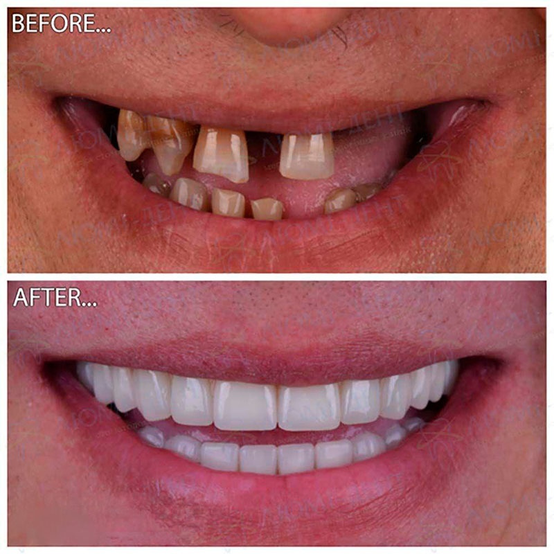 Photo before and after Lumi-Dent Photo-work-before-and-after-Lumi-Dent