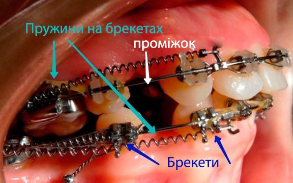 Пружина на брекетах фото Люмі-ДЕНТ