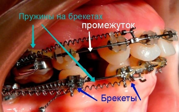 Пружина на брекетах фото Люми-ДЕНТ