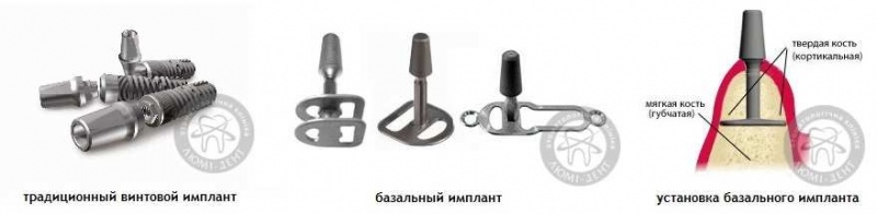 Классические и базальные зубные импланты Классические и базальные зубные импланты