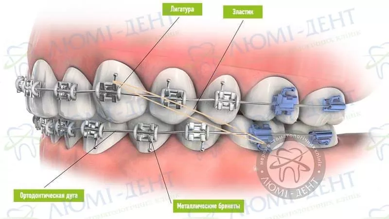 https://www.lumident.kiev.ua/images/files/filemanager/uslugi/Breket%20systemy/illustration-brekety_4188198273.webp