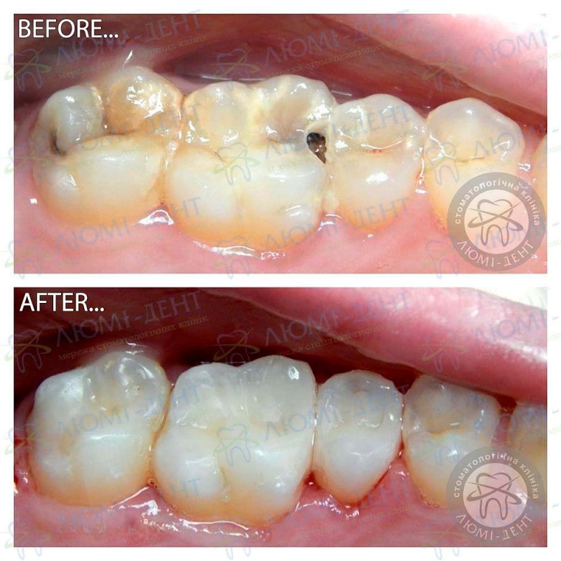 An example of a doctor's work Tooth treatment photo LumiDent