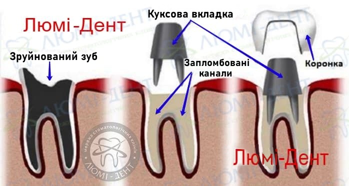 Коронка на штифте фото