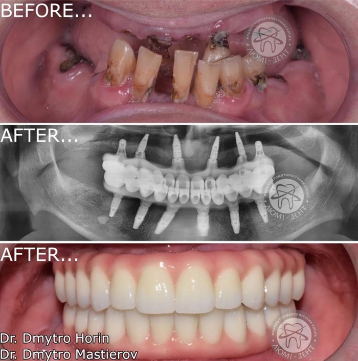 Протезування на імплантах фото Люмі-Дент