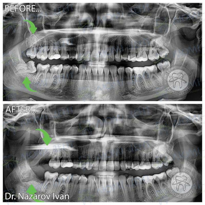 Удаление зуба мудрости Киев фото Люми-Дент