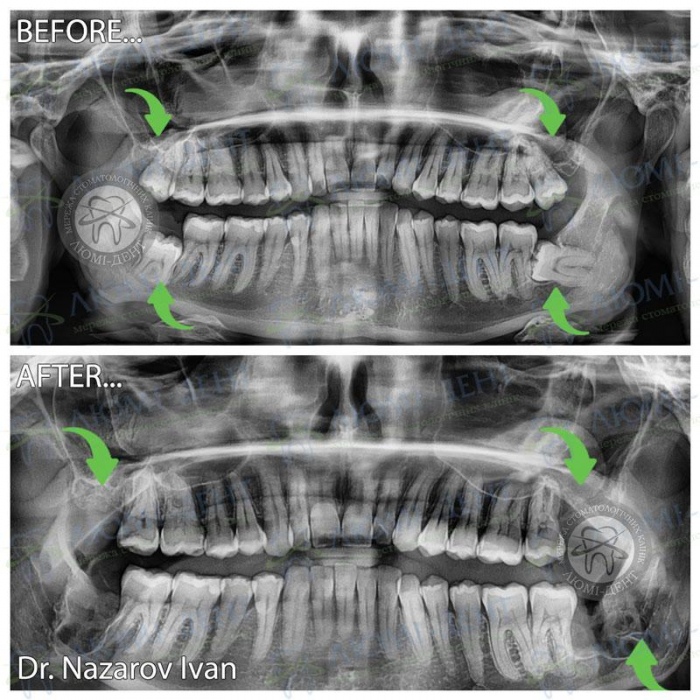 Удаление зубов мудрости Киев фото Люми-Дент