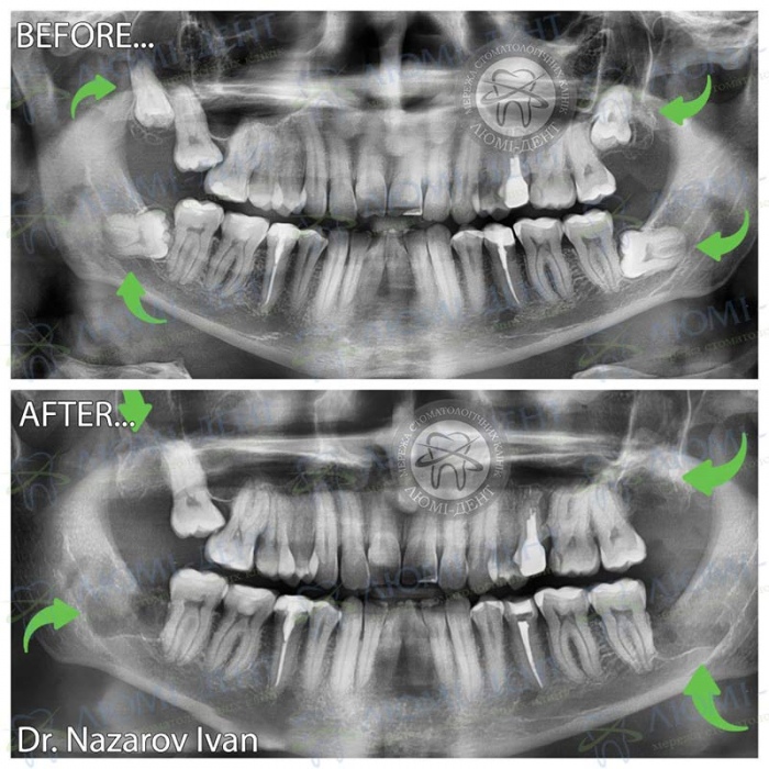 Зубы мудрости фото Люми-Дент