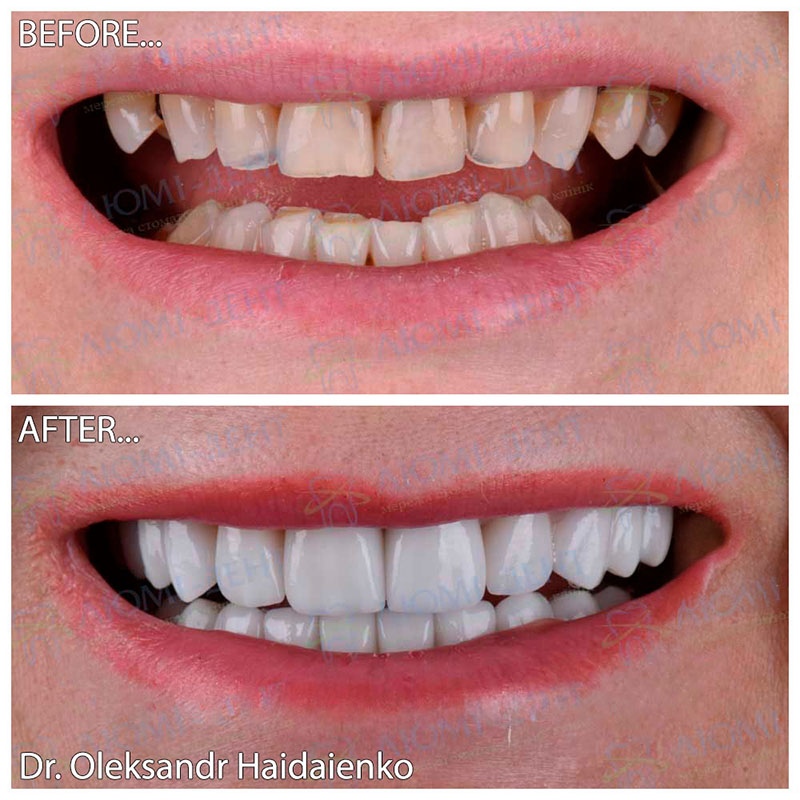 Before and after veneers Dental Veneers Lumi-Dent