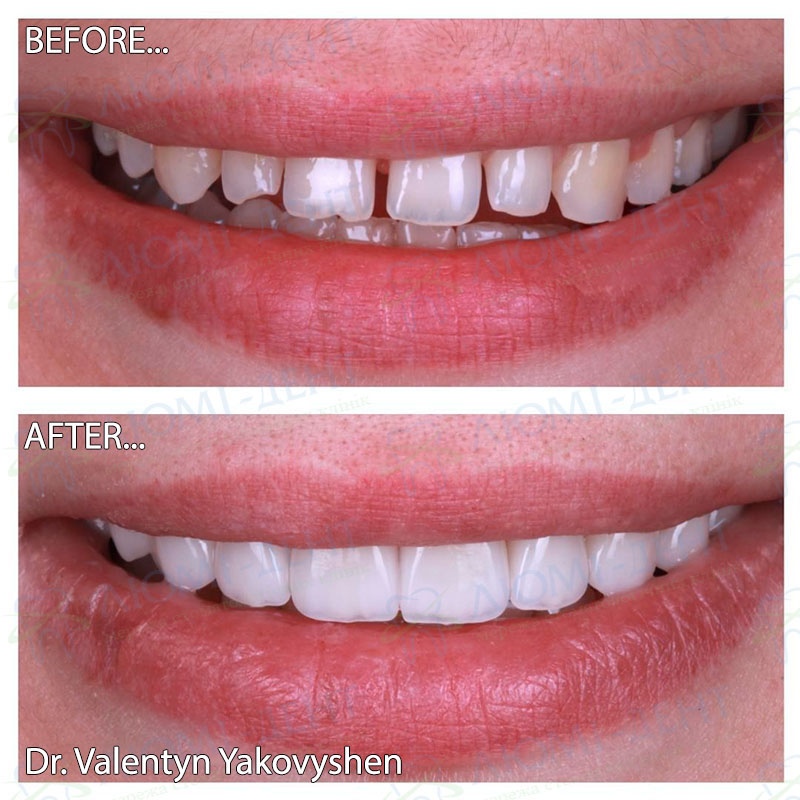 Before and after veneers Dental Veneers Lumi-Dent
