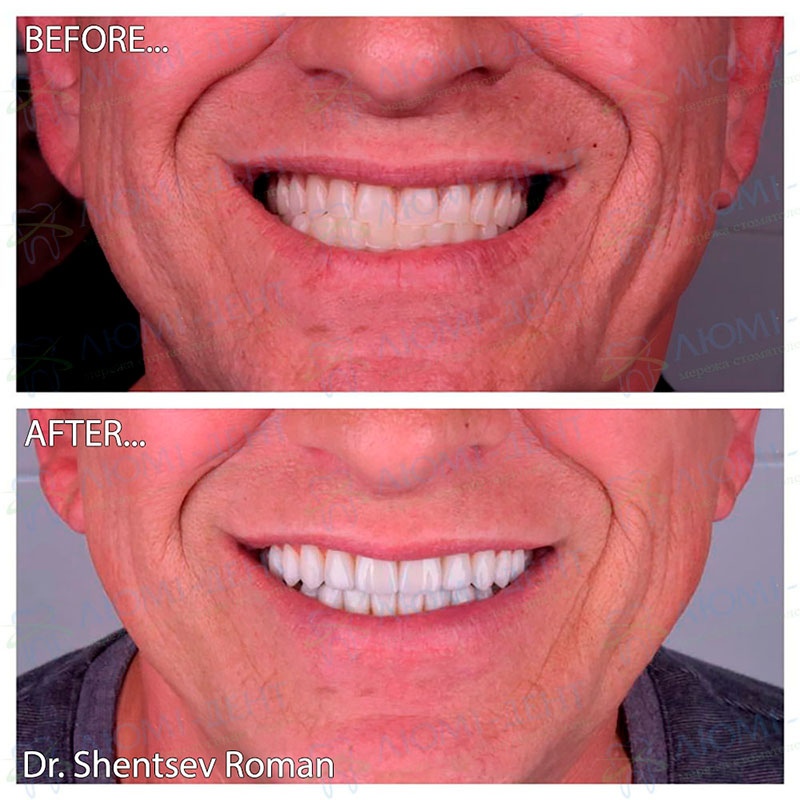 Before and after veneers at Lumi-Dent Dental Veneer Installation