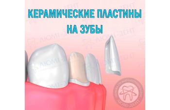 Керамические пластины на зубы
