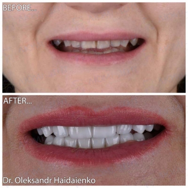 Dentistry «Lumi-Dent» in Kyiv Примеры работ доктора Гайдаенко А. В.