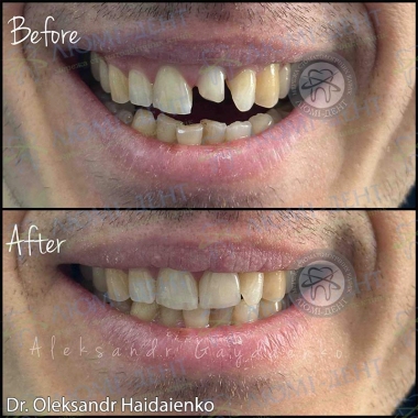 Dentistry «Lumi-Dent» in Kyiv Примеры работ доктора Гайдаенко А. В.