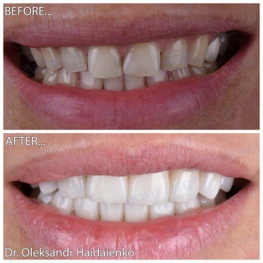 Dentistry «Lumi-Dent» in Kyiv Примеры работ доктора Гайдаенко А. В.
