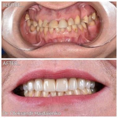 Dentistry «Lumi-Dent» in Kyiv Примеры работ доктора Гайдаенко А. В.