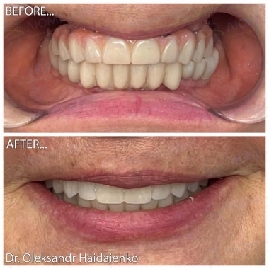 Dentistry «Lumi-Dent» in Kyiv Примеры работ доктора Гайдаенко А. В.