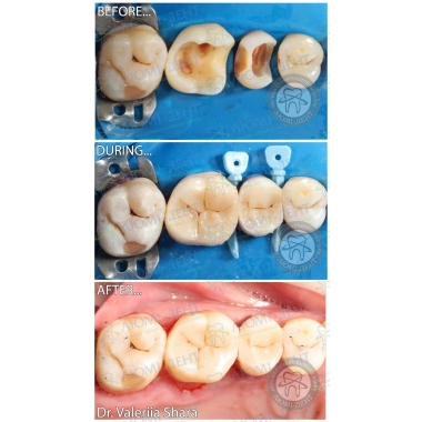 Пример работы врача стоматолога  Шары Валерии