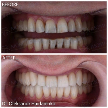Dentistry «Lumi-Dent» in Kyiv Примеры работ доктора Гайдаенко А. В.